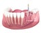 Endodontic root canal treatment process. Medically accurate tooth 3D illustration