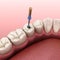 Endodontic root canal treatment process. Medically accurate tooth 3D illustration