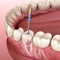 Endodontic root canal treatment process. Medically accurate tooth 3D illustration