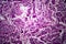 Endometrial adenocarcinoma, light micrograph