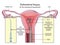 Endometrial biopsy diagram