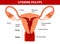 Endometrial polyp or uterine polyp