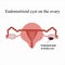 Endometrioid cyst on the ovary. Endometriosis. . Infographics. Vector illustration