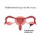 Endometrioid cyst on the ovary. Endometriosis. Ovary. Infographics. Vector illustration on isolated background
