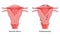 Endometriosis stages Female reproductive system normal and with disease pain uterus. Front view. Human anatomy internal