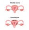 Endometriosis. The structure of the pelvic organs. Adenomyosis. The endometrium. Vector illustration