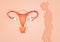 Endometriosis in uterus
