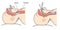 Endotracheal tube