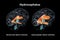 Enlarged lateral ventricles of the child brain and normal ventricular system, 3D illustration