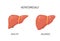 Enlarged liver hepatomegaly disease icon. Human liver health illustration anatomy design