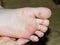 Enterovirus Feet Rash on the body of a child. Cocksackie virus rash beginning initial stage, spots on the feet