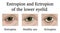 Entropion and Ectropion of the lower eyelid