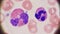 Eosinophil and neutrophil seen on peripheral blood smear