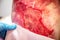 Epidermolysis bullosa disease, closeup wounds and cystics