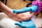 Epidermolysis bullosa, nurse put on some lotion on the foot