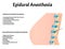 Epidural anesthesia during childbirth. Epidural anesthesia of pregnant women. Indications and contraindications. Vector