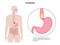 Esophageal achalasia disease