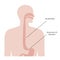 Esophageal achalasia disease