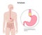 Esophageal achalasia disease