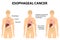 Esophageal Cancer