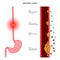 esophageal cancer stages