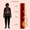 esophageal cancer stages