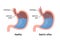 Esophageal gastric reflux acid indigestion. Gastrointestial stomach heartburn gerd gastric reflux