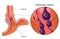 Esophageal varices medical illustration