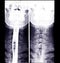 Esophagram or Barium swallow AP view.