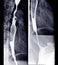 Esophagram or Barium swallow lateral view.