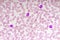 Essential thrombocytosis blood smear