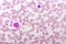 Essential thrombocytosis blood smear