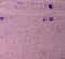 Essential thrombocytosis blood smear showing abnormal high volume of platelet and White Blood Cells. Panmyelosis.