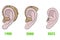 Evolution of cochlear implant through the years. From big to small