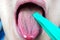 Examination of the human tongue organ, diseases and manifestations of diseases on the surface of the tongue, structure and relief