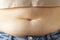 Excess fat on abdomen close up, the concept of weight loss