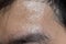 Excessive sweating or hyperhidrosis and oily skin at forehead of Asian, Myanmar or Chinese adult young man