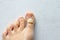 Exfoliation of nail on big toe, close-up in woman, girl. Toenail damage, fungus, trauma, big toe nail problems, nail detachment,