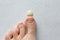 Exfoliation of nail on big toe, close-up in woman, girl. Toenail damage, fungus, trauma, big toe nail problems, nail detachment,