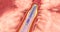 The expanded stent restores blood flow and will remain in the artery after the coronary stenting procedure