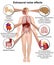 Extraaural health effects of chronic noise exposure medical  illustration