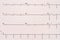 Extrasystole On 12 Lead Electrocardiogram Paper