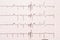 Extrasystole On 12 Lead Electrocardiogram Paper