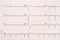 Extrasystole On 12 Lead Electrocardiogram Paper