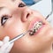 Extreme close up of hands working on dental braces.