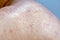 Extreme close-up photography of the atocpic dermatitis