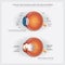 Eye Anatomy with Eye Abnormalities