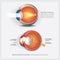 Eye Anatomy with Eye Abnormalities