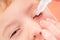 Eye child allergy and conjunctivitis red allergic, ill inflammation