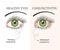 Eye disease. Ophthalmology health illustration.